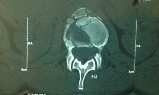 L2 Burst Fracture. The lateral cuts show retropulsion into the spinal canal. There was no spinal cord injury. The patient awlays had a normal nauerological exam.