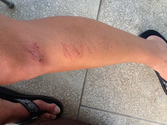 The injury that should've put an end to hiking in flip flops