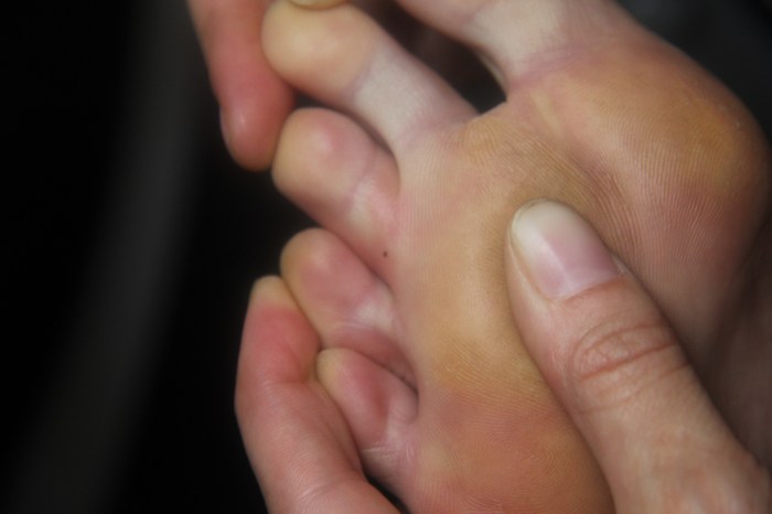 Entrance Wound on my 3rd toe